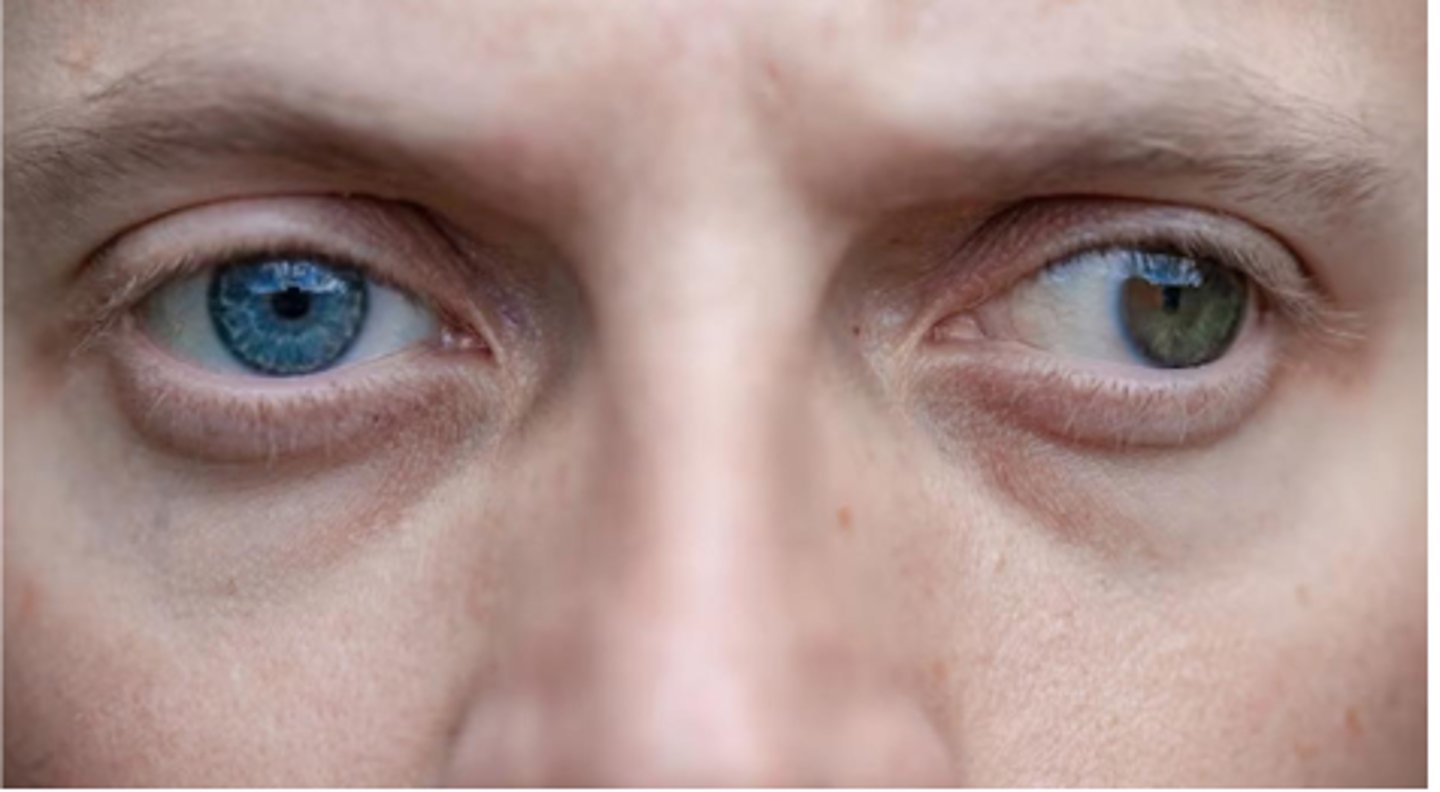 <p>- One eye goes out of alignment when tired</p><p>- Not constant</p><p>- Daydreaming</p>