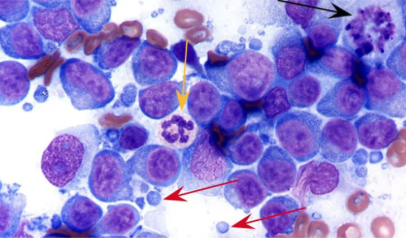 <p>Monomorphic population of lymphoid cells: <span style="background-color: transparent;"><span>>50% intermediate/large lymphocytes&nbsp;</span></span></p>
