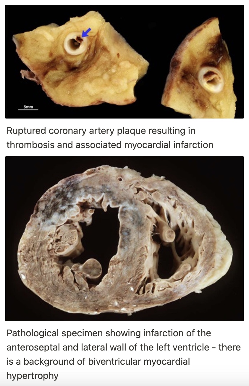 <p>Once a plaque has formed, complications can develop:</p><ul><li><p>The plaque forms a physical blockage in the lumen of the coronary artery - this may cause reduced blood flow and hence oxygen to the myocardium, particularly at times of increased demand, resulting clinically in angina</p></li><li><p>The plaque may rupture, potentially causing a complete occlusion of the coronary artery - this may result in an MI</p></li></ul>