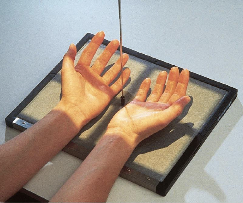 <p><span style="line-height: normal;">-&nbsp;</span>Special projection for early detection of rheumatoid arthritis and fractures at the base of the 5<span style="line-height: normal;">th</span> metacarpal</p><p class="p1"><span style="line-height: normal;">-&nbsp;</span>Both hands are imaged together</p><p class="p1"><span style="line-height: normal;">-&nbsp;</span>This projection is usually substituted for the PA oblique</p><p class="p1"></p><p class="p1">Patient Position</p><ul><li><p class="p1">Sitting facing the table</p></li></ul><p class="p1">Part Position</p><ul><li><p class="p1"><span style="line-height: normal;">&nbsp;</span>Both hands ;with posterior aspect against the IR</p></li><li><p class="p1"><span style="line-height: normal;">&nbsp;</span>Hands internally obliqued 45⁰</p></li><li><p class="p1"><span style="line-height: normal;">&nbsp;</span>Fingers extended ( can be slightly flexed)</p></li><li><p class="p1"><span style="line-height: normal;">&nbsp;</span>Thumb slightly abducted to prevent superimposition over metacarpals</p></li><li><p class="p1"><span style="line-height: normal;">&nbsp;</span>Note: this can be difficult for patients with advanced disease</p></li></ul><p class="p1">CR</p><ul><li><p class="p1">Centered between hands @ level of MCP’s</p></li></ul><p class="p1">Collimation</p><ul><li><p class="p1">Same as PA /PA Oblique</p></li></ul><p></p>
