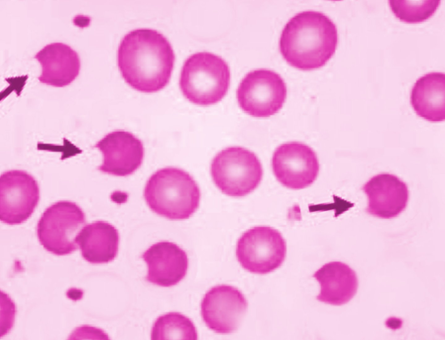 <p><strong><mark data-color="yellow" style="background-color: yellow; color: inherit;">G6PD deficiency</mark></strong><mark data-color="yellow" style="background-color: yellow; color: inherit;"> </mark>so the red cell will build oxidized hemoglobin so a clump forms and macrophages bit the oxidized part out&nbsp;</p>