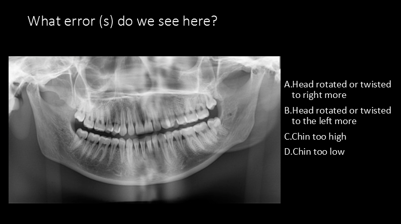 <p>What error (s) do we see here?</p><p>A. Head rotated or twisted to right more</p><p>B. Head rotated or twisted to the left more</p><p>C. Chin too high</p><p>D. Chin too low</p><p></p>