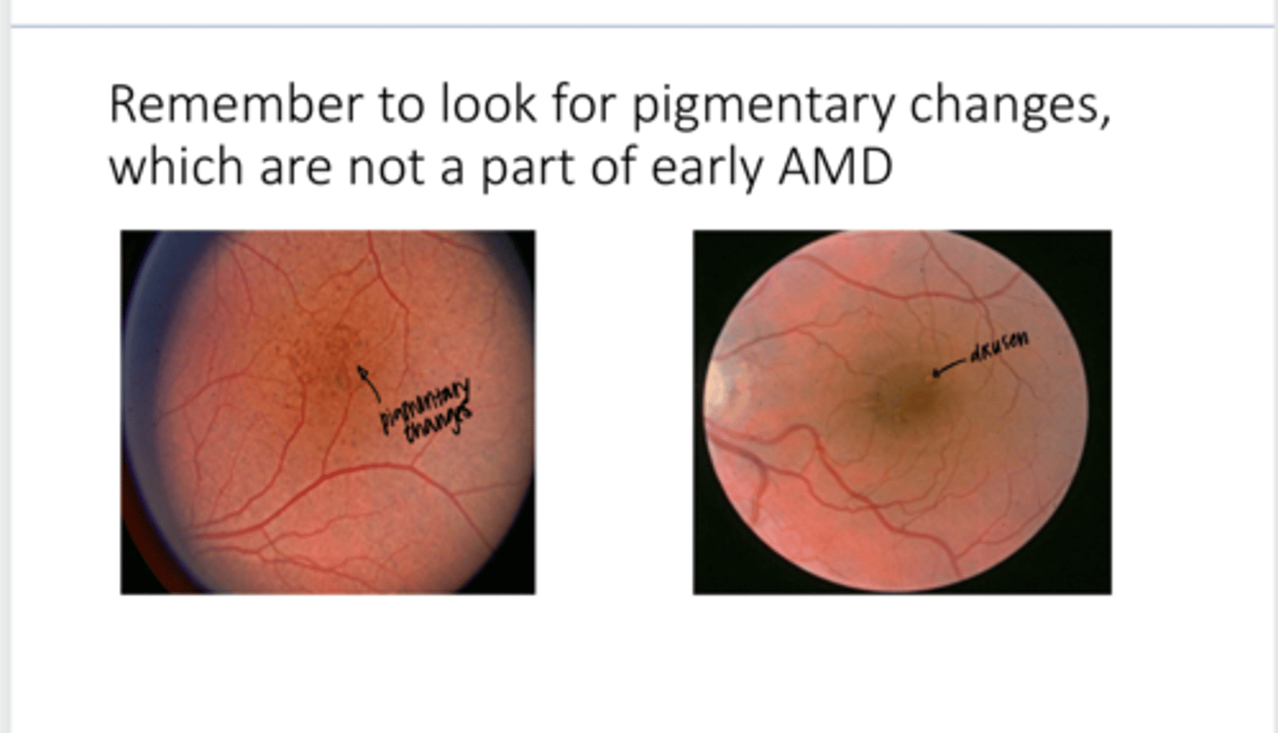 <p>REVIEW: Are pigmentary changes a part of EARLY AMD according to the table Fogt gave us?</p>