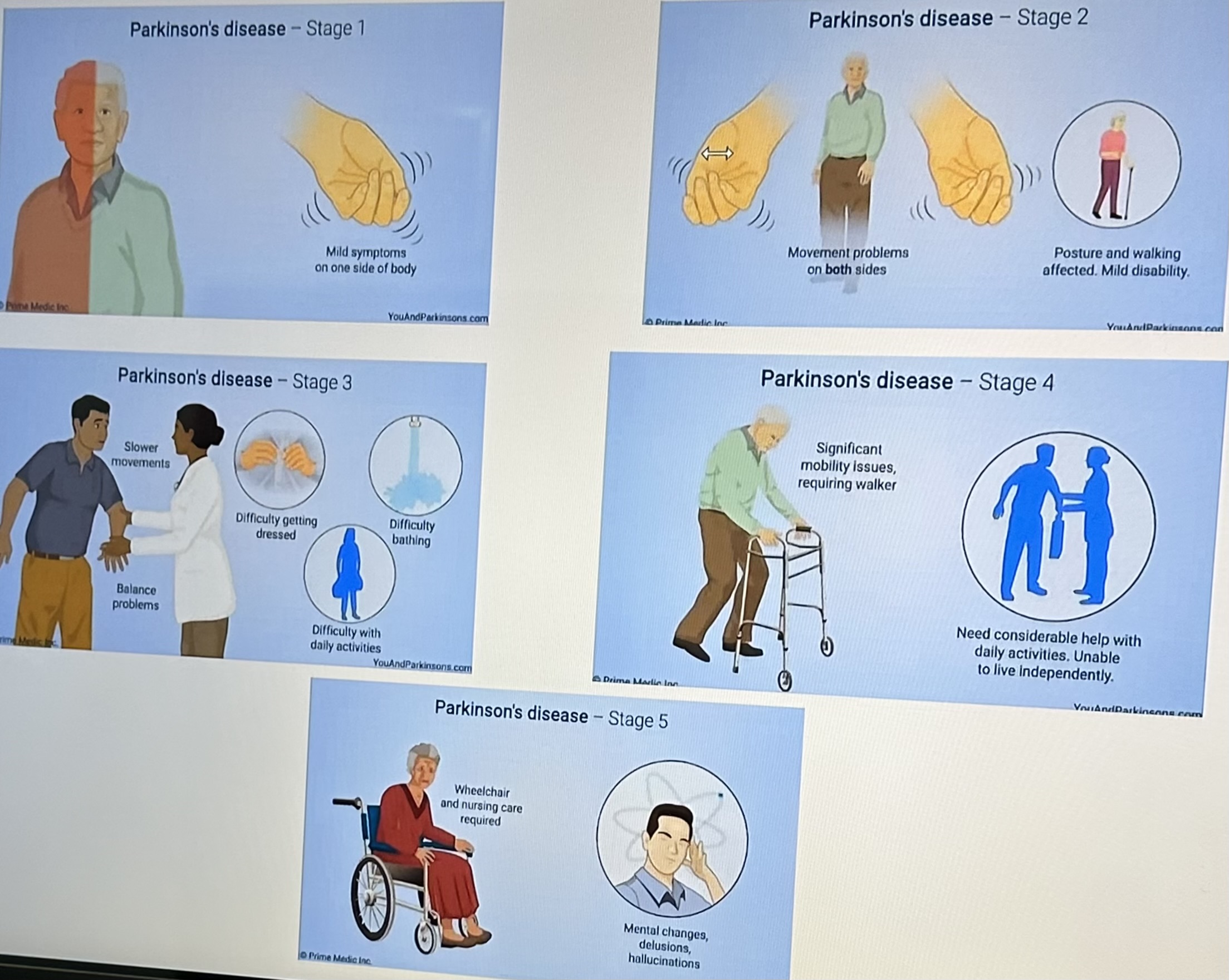 <p>Stage<strong> I</strong></p><ul><li><p><strong>Unilateral</strong> tremor</p></li><li><p>Minimal-no functional impairment</p></li></ul><p>Stage <strong>II</strong></p><ul><li><p><strong>Bilateral</strong> tremor</p></li><li><p>Independent with ADL</p></li><li><p>No balance impairment</p></li></ul><p>Stage <strong>III</strong></p><ul><li><p>first signs of impaired righting reflexes</p></li><li><p>onset of <strong>disability in ADL</strong> performance (min A)</p></li><li><p>can lead <strong>independent</strong> life</p></li><li><p>Start to see <strong>high fall risk</strong></p></li></ul><p>Stage <strong>IV</strong></p><ul><li><p>requires help with some or all ADL</p></li><li><p><strong>Unable to live alone without some assistance</strong></p></li><li><p>Able to walk/stand (with walker)</p></li></ul><p>Stage <strong>V</strong></p><ul><li><p><strong>Unable</strong> to stand/walk</p></li><li><p><strong>Unable</strong> to perform ADLs</p></li><li><p><strong>W/C and Max A</strong> are required</p></li></ul><p></p>