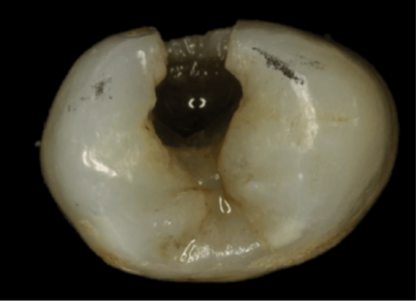 <p>a little hole that can develop in your teeth. It's like a tiny hole that can grow bigger if you don't take care of your teeth</p>