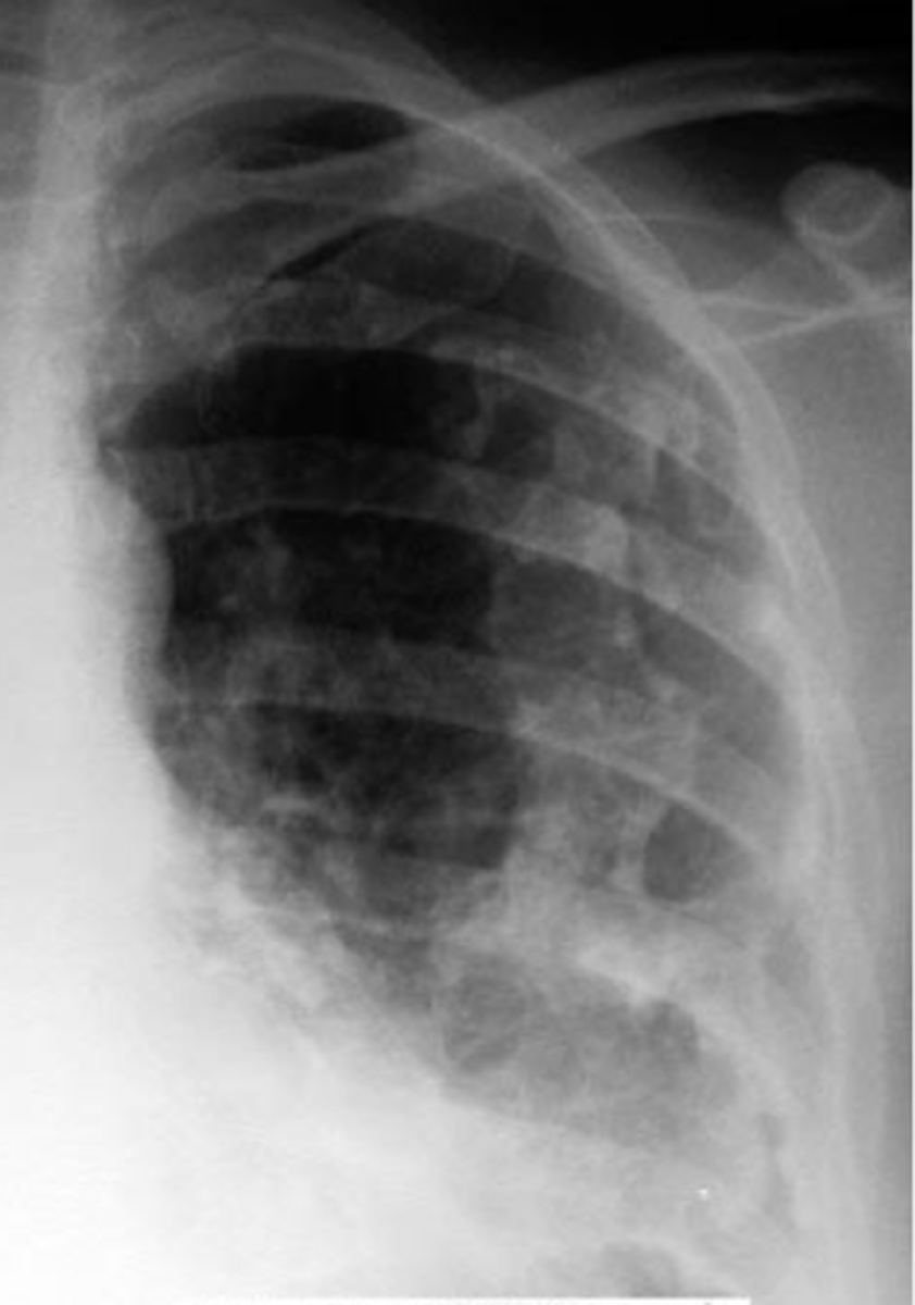 <p><b>EXPOSURE to asbestosis not necessarily lung impairment</b><br>-these plaques are best evaluated by CT scan</p>