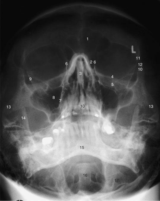 <p>Waters - the structure illustrated as # 13 is the:</p><p>a. Frontal process of zygoma</p><p>b. Zygomatic arch</p><p>c. Zygomaticofrontal suture</p><p>d. Maxillary sinus</p><p>e.  Transverse process and foramen transversarium of C1</p><p>f. Body of mandible</p><p>g.  Infraorbital foramen</p><p>h. Frontal sinus Coronoid process of mandible</p><p>I. Nasal septum</p><p>J. Odontoid process of C2</p><p>k.  Ethmoid sinus</p><p>L. Zygomatic process of frontal bone</p><p>m. Inferior orbital rim</p><p></p>