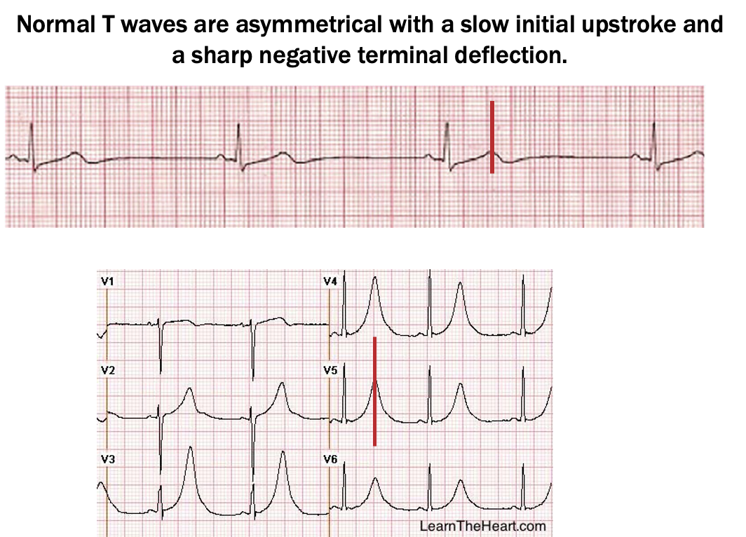 <p>broad, inc in amplitudes and symmetrical</p>