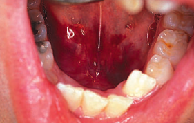 <p><span>consists of</span> extravasated <span style="color: red;">blood pooling under the epithelium</span> or deep in the connective tissue or <span>muscle, usually because of blunt trauma</span></p><ul><li><p><strong>cause:</strong></p><ul><li><p>usually due to <span style="color: red;">blunt trauma</span></p></li><li><p>occurs more often in individuals<span style="color: red;"> with bleeding disorders</span></p></li><li><p>occasionally administration of an<span style="color: red;"> inferior alveolar nerve block</span> </p></li></ul></li></ul><ul><li><p><strong>treatment:</strong></p><ul><li><p>can be expected to <span style="color: red;">resolve spontaneously</span></p></li></ul></li></ul><p></p>