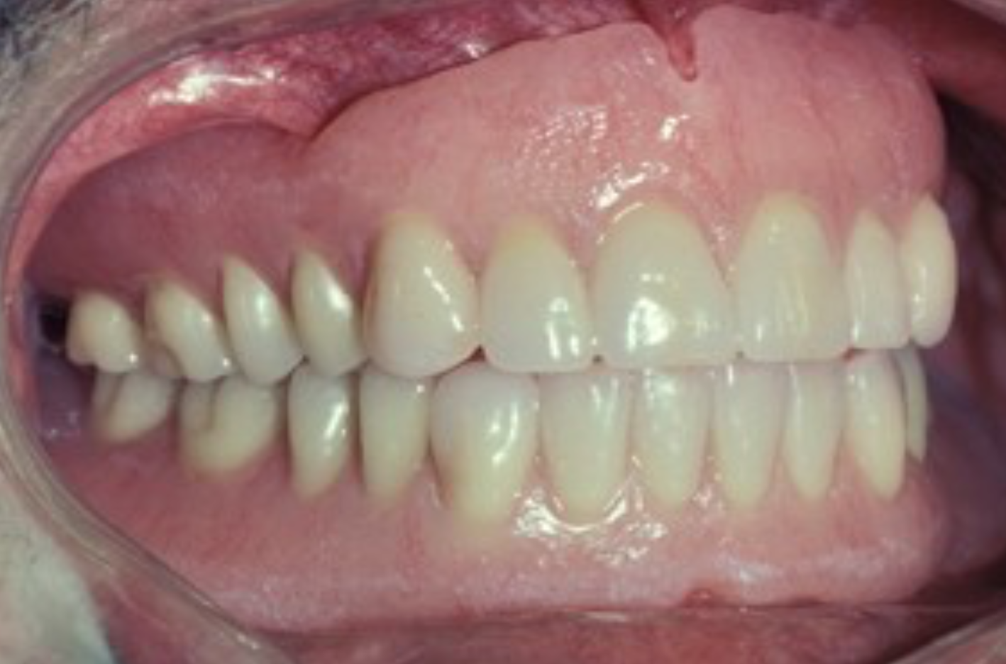 <p>A removable dental prosthesis that replaces the entire dentition and associated structures of maxilla or mandible</p>