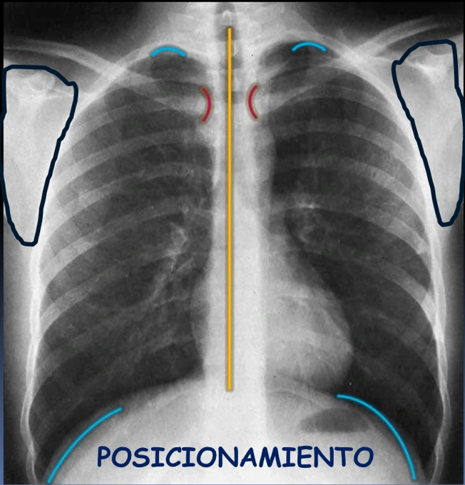 <ol><li><p><span style="color: red"><strong>Paciente en bipedestación</strong></span> (se busca la burbuja gástrica) y de <strong>posteroanterior (Escápulas fuera de los campos, Forma de S), anteroposterior (Escápulas superpuestas)</strong></p></li><li><p><span style="color: red"><strong>En apnea e inspiración profunda</strong></span> <span style="color: red"><strong>(9 a 10 arcos costales posteriores, 5 a 6 arcos costales anteriores)</strong></span></p></li><li><p><span style="color: red"><strong>Imagen centrada</strong></span> (<strong>Linea imaginaria a través de la hipófisis espinosa y distancia con las clavículas)</strong></p></li><li><p><span style="color: red"><strong>Omóplato debe estar afuera del campo pulmonar (abrazo)</strong></span></p></li><li><p><span style="color: red"><strong>Dosis de radiación:</strong></span> Kilovoltaje alto (la <strong>columna no deberí ser exageradamente blanca</strong>, si las estructuras vasculares se ven en el corazón entonces estaría bien)</p></li><li><p><span style="color: red"><strong>Incluir todo el tórax </strong></span>(desde los ápices hasta los senos costo frénicos)</p></li></ol><p></p>