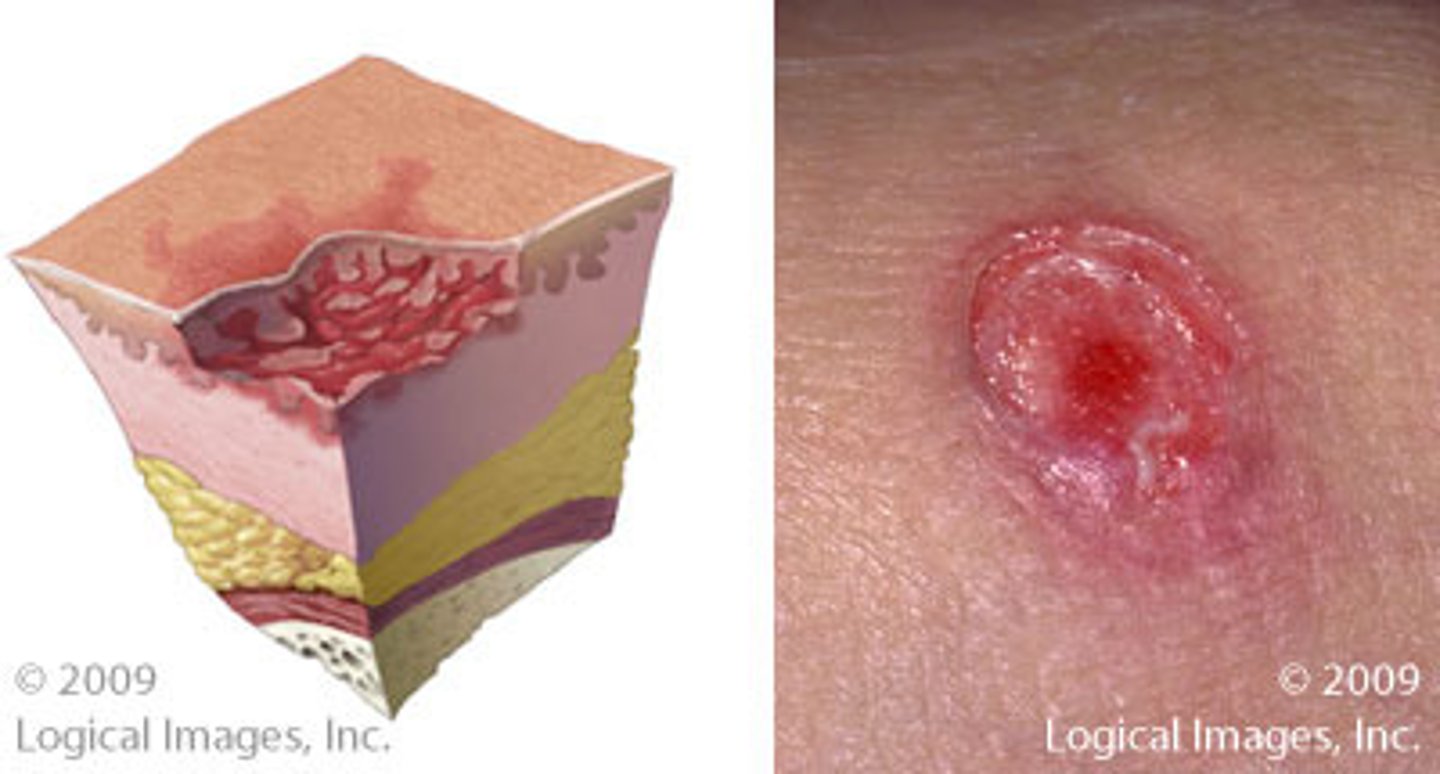 <p>Loss of epidermis +/- some dermis</p><p>Stage 2 pressure ulcer, blister, skin tear</p><p>No slough โ heal through epithelialization rather than granulation tissue</p><p>Less scarring</p>