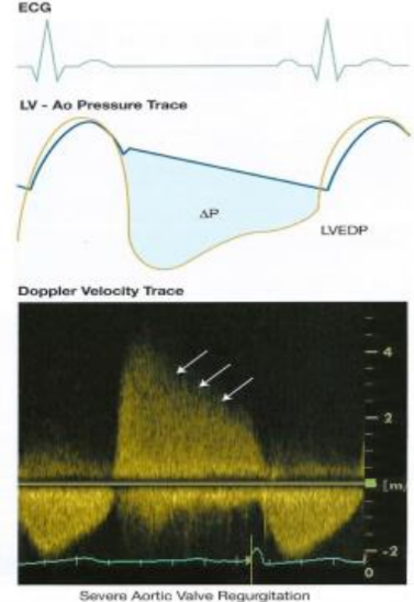 <p>Because the larger the opening of the closed AOV, the faster the aorta empties into the LV, the faster the aortic pressure drop, the faster the LV pressure rises.</p>