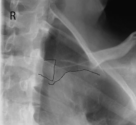 <p>OBL SC joint - what is this rotation like?</p>