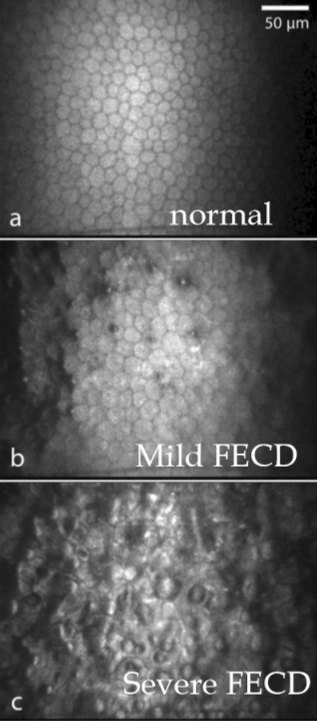 <p>There is a gradual loss of endothelial cells, which appears as <strong>guttata formation</strong>. As endothelial cell density decreases, the guttata expand, leading to mild corneal edema. Over time, the severity of edema increases, resulting in <strong>corneal opacification, pain, and vascularization</strong>.</p>