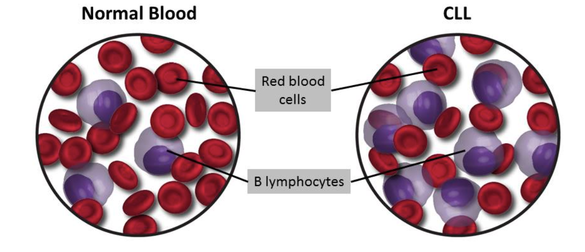 <p>KLL är det näst vanligaste lymfomet (25%). Indolent lymfom med klonal expansion av B-lymfocyter → de flesta celler måste vara mogna (&gt;80%). För diganos kan man ta blodprov eller benmärgsutstryck och biopsi av lymfnod.</p><p>Monoklonala B-celler akcumuleras i blod, benmärg och eventuellt i lymfnoder och mjälte.</p><p>Vanligare hos män än kvinnor. Ger upphov till <strong>lymfocytos</strong> i blodet och klassiska lymfom-symptom.</p><p>Kan även leda till trombocytopeni och anemier.</p>