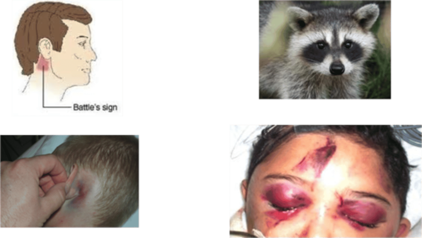 <p>• Raccoon eyes</p><p>• Battle's sign</p><p>• Blood pooling behind the eardrum</p><p>• Leakage of cerebrospinal fluid</p>