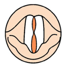 What type of VF closure is this?
