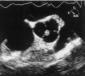 <p><span>Identify the cardiac pathology demonstrated in the image.</span></p><p>Aortic valve mass</p><p>Papillary fibroelastoma</p><p>Aortic stenosis</p><p>Aortic valve vegetation</p>