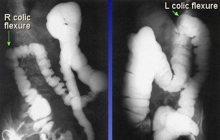 <p>What is this x-ray demonstrating?</p>