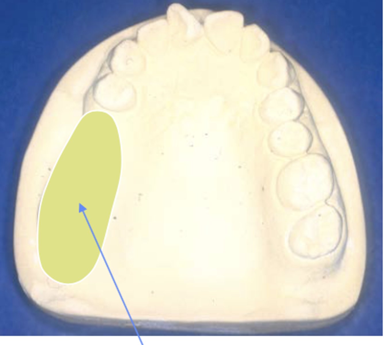 <p>Kennedy classification:</p><p>- unilateral edentulous area located posterior to the natural teeth</p>
