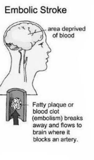 <p>when the coating on the walls of the vein breaks free and clogs a vein preventing blood from getting through&nbsp;</p>