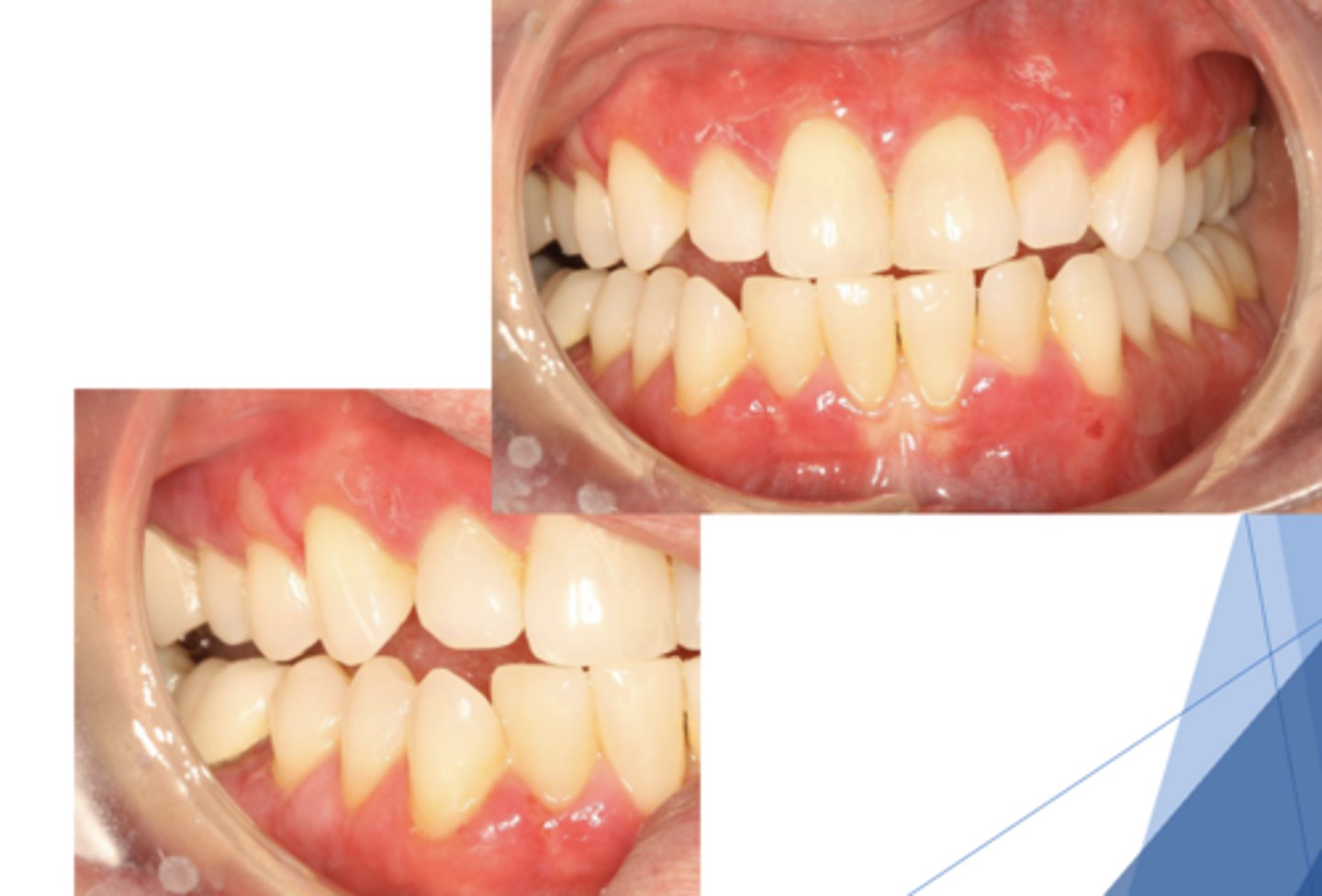 <p>Patient presents with these lesions along with ocular lesions and an autoimmune disorder with autoantibodies to hemidesmosomes. What condition do you suspect?</p>