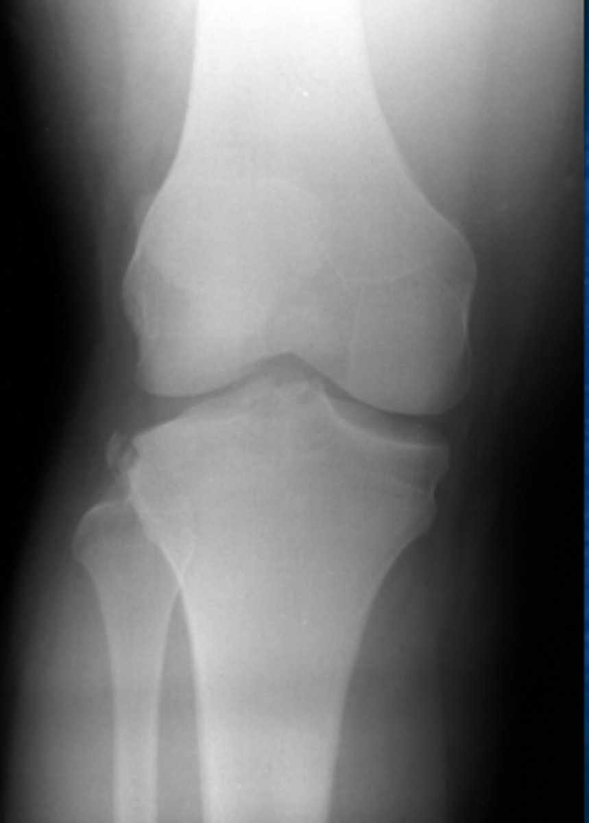 <p>Avulsion of lateral tibial plateau- associated with ACL and IT band injury. Thought to represent detachment of the lateral capsular ligament.</p>