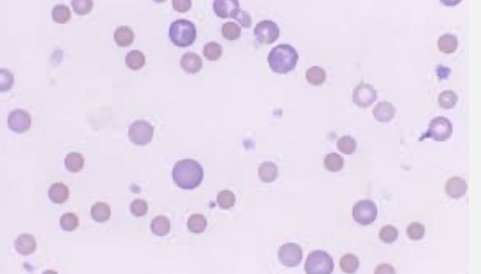 <p>What type of smear cell and what conditions is it seen in</p>