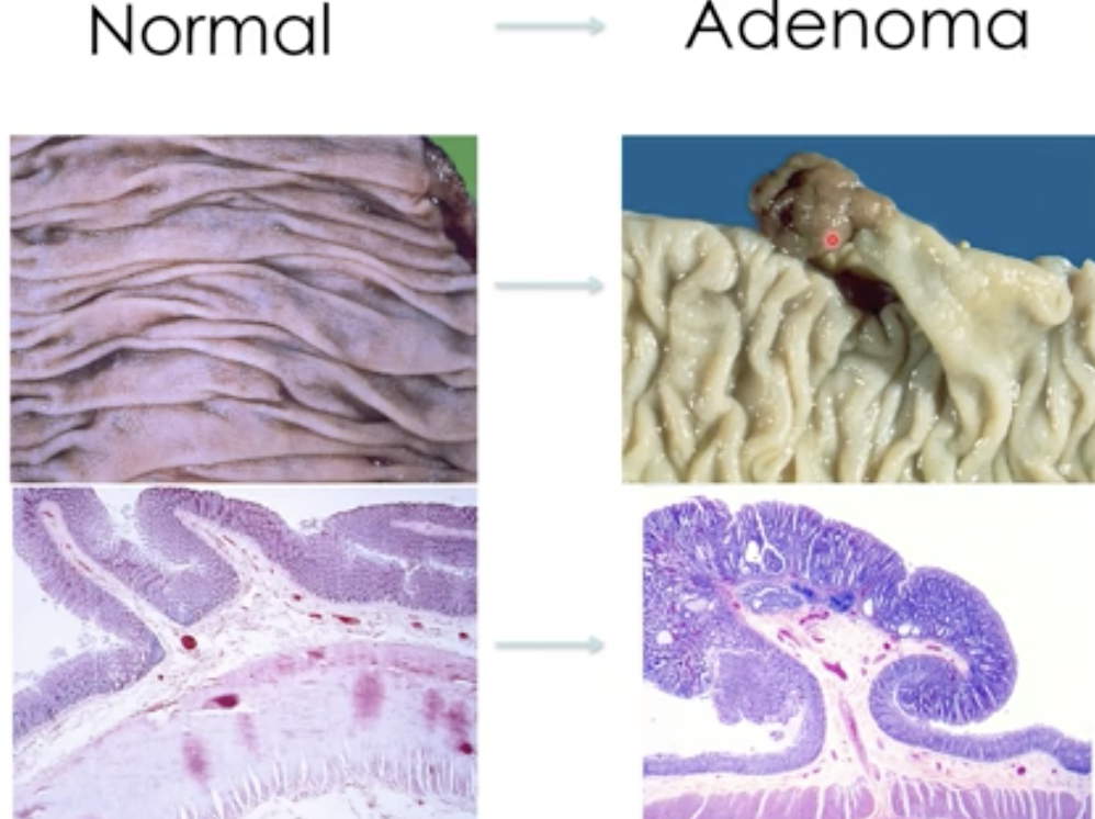 A type of polyp that is caused by dysplasia and results in adenocarcinoma - A precursor to colorectal cancer 