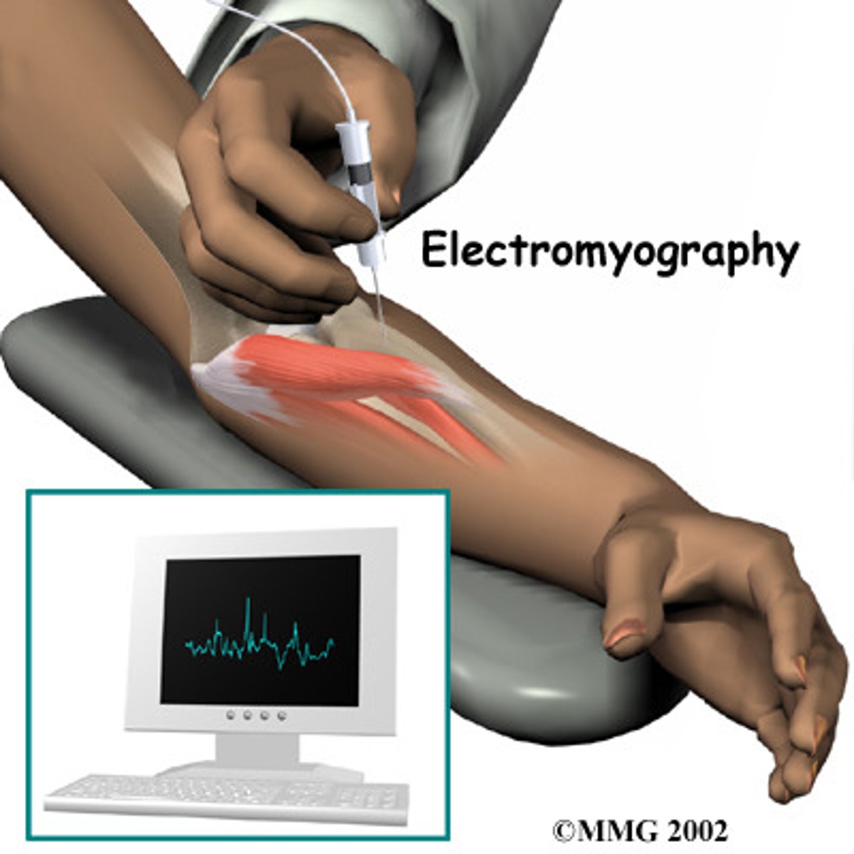 <p>electromyogram</p>