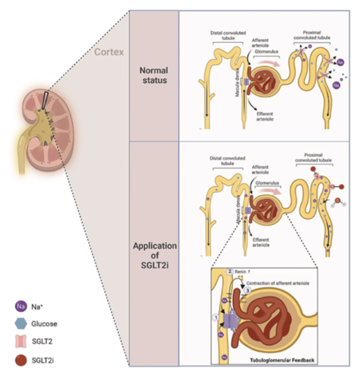 <p>- selectively and reversibly inhibit the SGLT2 in PCT of nephron</p><p>- SGLT2 mediates active transport of glucose and Na from filtrate into blood</p><p>- SGLT2 inhibition impairs glucose reabsorption in the nephron, increasing renal excretion of glucose (glycosuria)</p><p>- increased renal Na/H2O excretion reduces extracellular water vol, blood pressure and cardiac preload</p><p>- overall triggers tubuloglomerular feedback mechanisms that reduce intra-glomerular pressure</p>