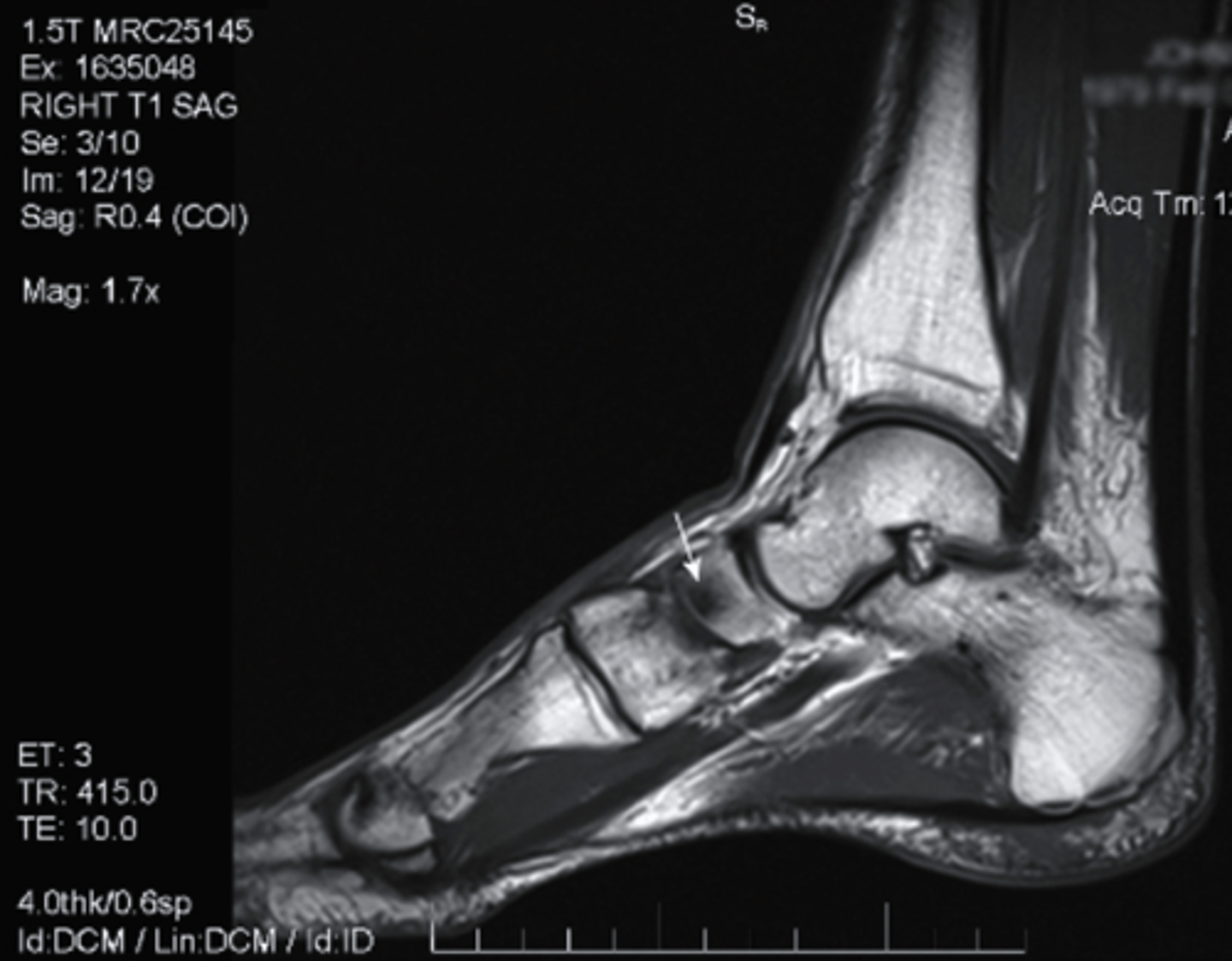 <p>what can be seen in this MRI?</p><p>a. bone tumor</p><p>b. bone marrow edema</p><p>c. fracture in the bone</p><p>d. bone bruising</p>