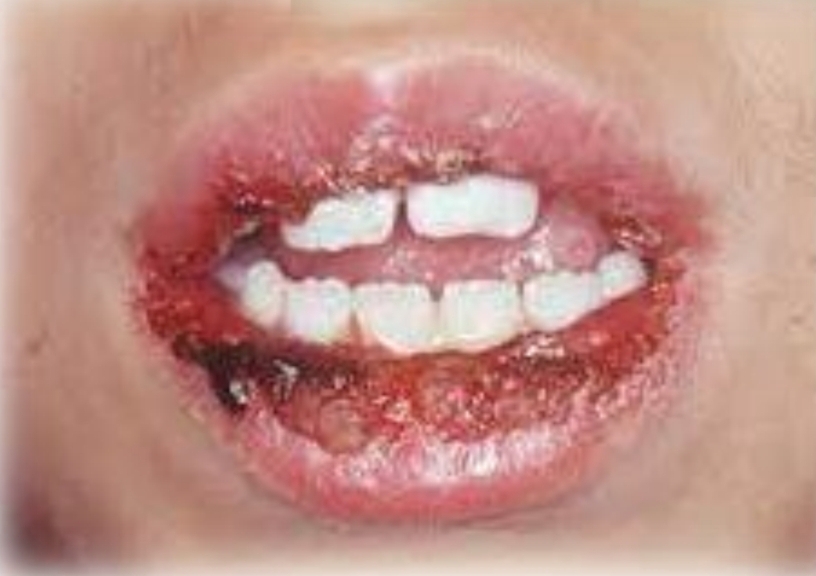 <p>Widespread and painful, red macules, vesicles, bullae and ulcers. Blood crusted lesions on lips. Target lesions on skin.</p><p class="has-focus">Acute onset, fever, malaise</p><p class="has-focus">Second decade</p><p class="has-focus">Male prediliction</p><p class="has-focus"><strong>Found on:</strong></p><p class="has-focus">Oral lesions: Lips, tongue, buccal mucosa, soft palate</p><p class="has-focus">Skin ‘Target’ lesions on: Extremities and head and neck region</p>