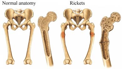 <p>during bone development (usually seen in kids), a lack of calcium and/or vitamin D can lead to a deficiency in calcium in the bone. Osteomalacia is the general term for soft bones.</p>