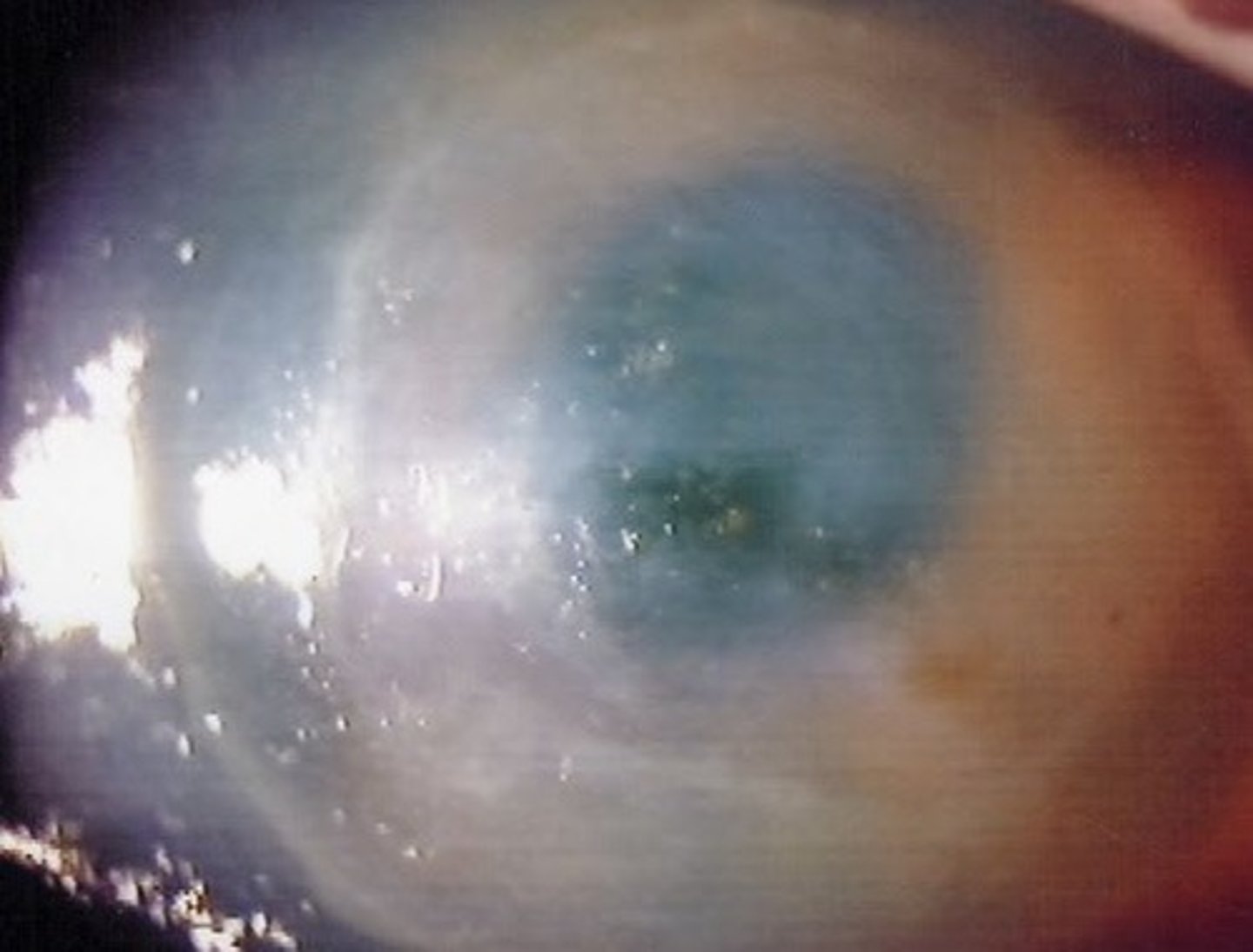 <p>57.7% of patients with anesthetic abuse keratopathy have a ____________________ opacification.</p>