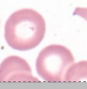 <p>What are these pale cells called and what causes them?</p>