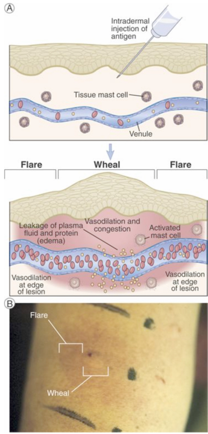 <p>Mast cell mediators → Wheal (redness and local swelling) - dilation of local blood vessels</p><p>→ flare (red rim) - dilation of vessels in the edge</p><p></p><p><span><span>In response to antigen-stimulated release of mast cell mediators, local blood vessels first dilate and then become leaky to fluid and macromolecules, which produces redness and local swelling (a wheal). Subsequent dilation of vessels on the edge of the swelling produces the appearance of a red rim (the flare). </span></span></p><p><span><span>B. Photograph of a typical wheal and flare reaction in the skin in response to injection of an allergen.</span></span></p>