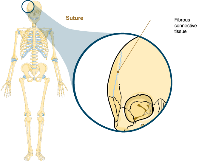 <p><span><span>A suture is the narrow fibrous joint found only between most bones of the skull. </span></span></p><p></p><p><span><span>All the bones of the skull, except for the mandible, are jointed to each other by a fibrous joint called a&nbsp;</span><strong><span>suture</span></strong></span><strong> (Figure 4.10).&nbsp;</strong></p><p></p><p><span><span>The short, fibrous connective tissue found at a suture strongly unites the adjacent skull bones, protecting the brain and forming the face. </span></span></p><p></p><p><span><span>In adults, the skull bones are close together, and fibrous connective tissue fills the narrow gap between the bones. the suture is frequently convoluted, forming a tight union that prevents most movement between the bones.</span></span></p><p></p><p><span><span> Sutures are functionally classified as a&nbsp;</span></span><em>synarthrosis</em><span><span>, although some sutures may allow for slight movements between the cranial bones.</span></span></p>