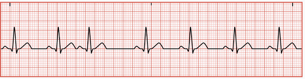 <p>occur when irritated atrial tissue fires an early electrical impulse before the next normal impulse is expected from the SA node </p><p>causing the heart’s electrical conduction system to activate an early heartbeat or impulse from one of the two atrial chambers&nbsp;</p>