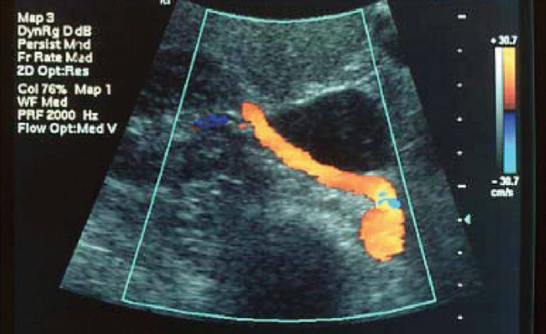 <p>In this image, the RRA is seen from aorta to hilum of kidney. Which portion of RRA is proximal and which is distal? </p>