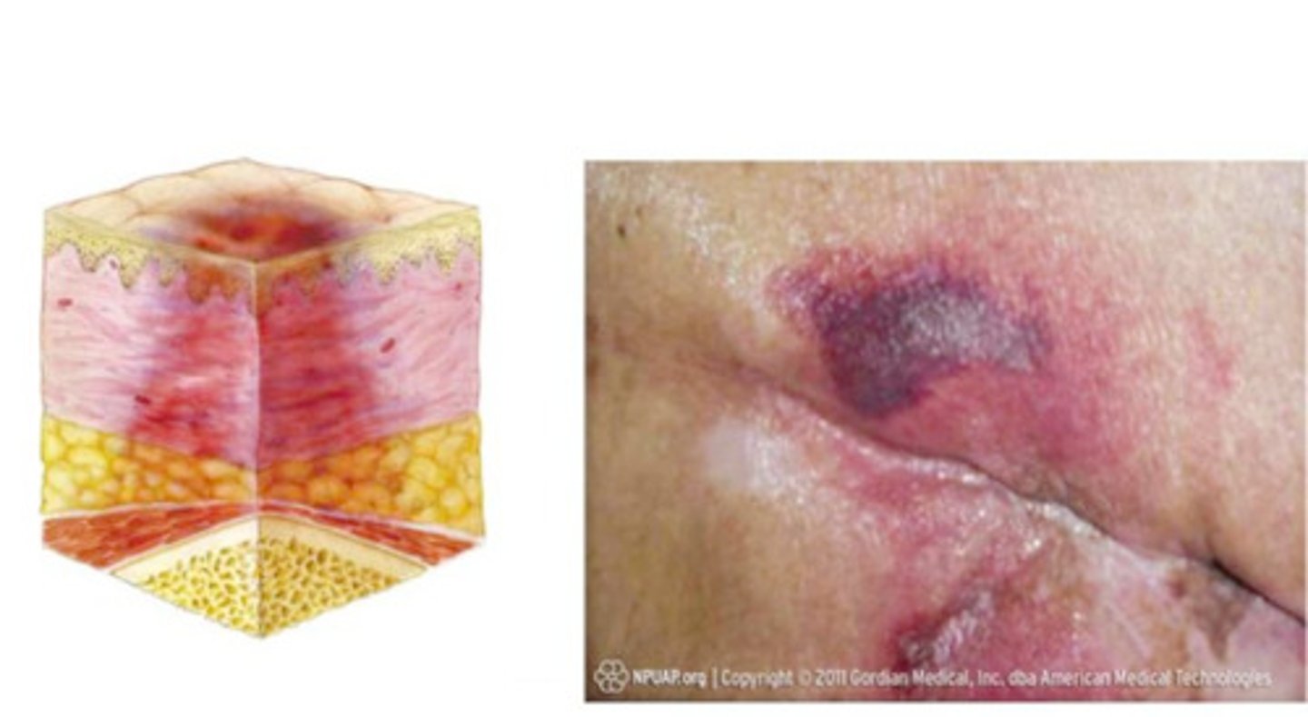 <p>persistent non-blanchable deep red, maroon, or purple discoloration</p>