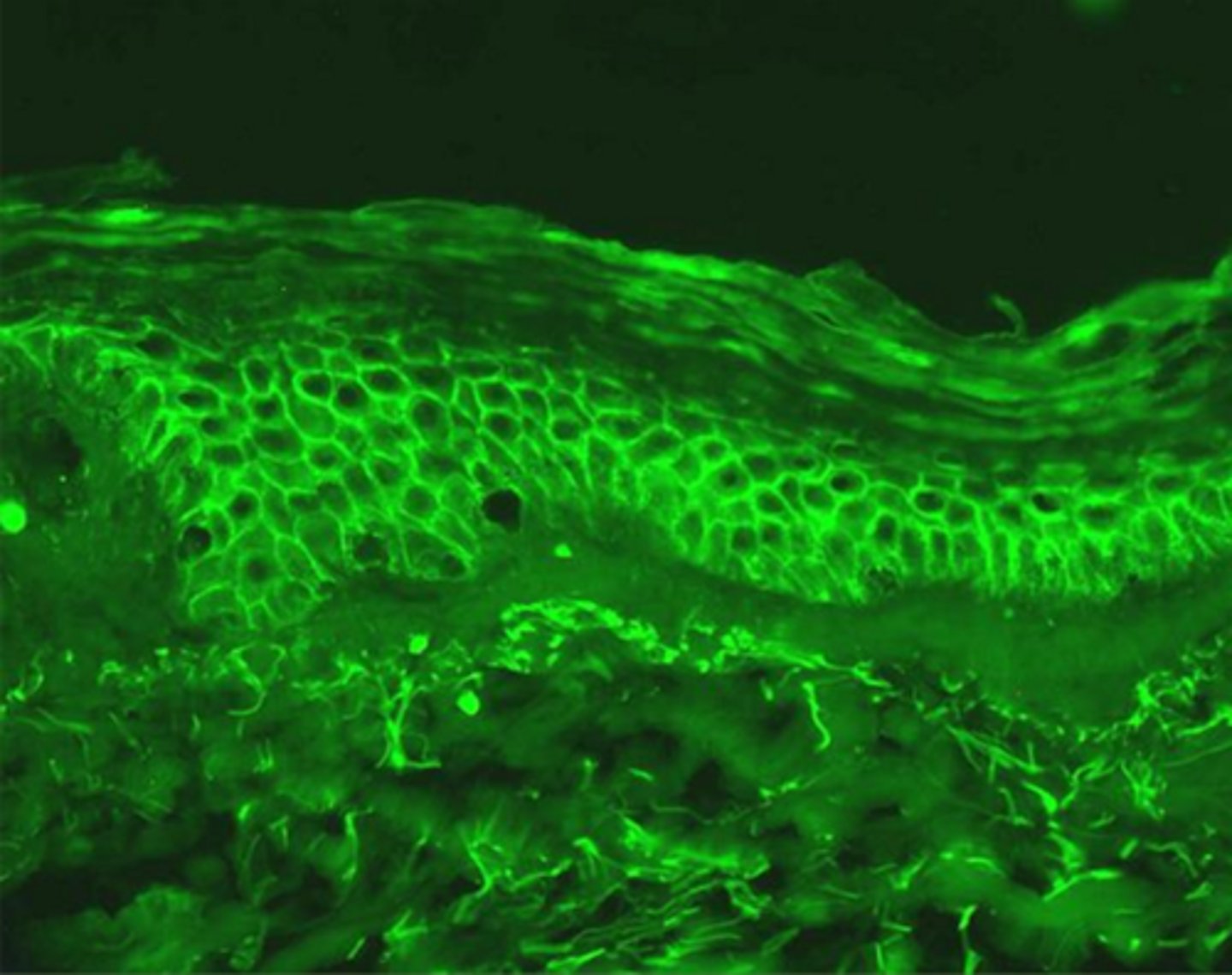 <p>which pemphigus?</p>