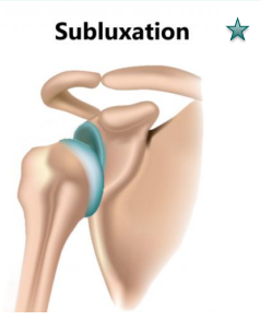 <p><strong>Subluxation- </strong>partial dislocation</p><p><strong>Full luxation- </strong>full dislocation</p>
