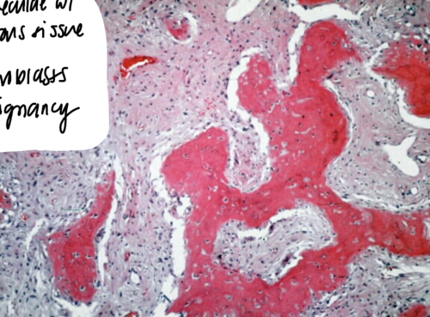 <p>Normal trabeculae w/ a lot of fibrous tissue in between</p><p>- Normal fibroblasts</p><p>- Not a malignancy</p>