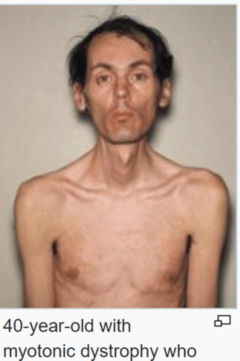 <p>Slow progression of weakness starting in the face, lower legs, forearms, hands, and neck.</p><p>Muscles lock, followed by delayed relaxation.</p><p>Many organs affected, especially the heart</p>