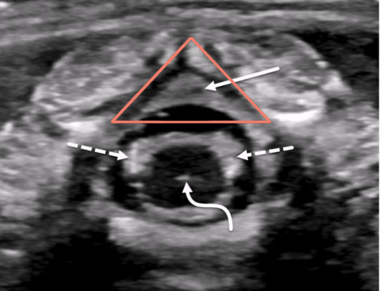 <p>solid white arrow</p>