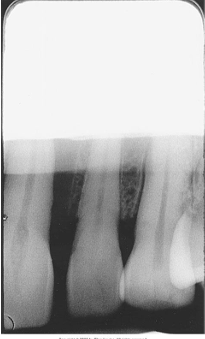 <p>How would you resolve this DEVELOPER CUT-OFF X-ray?</p>