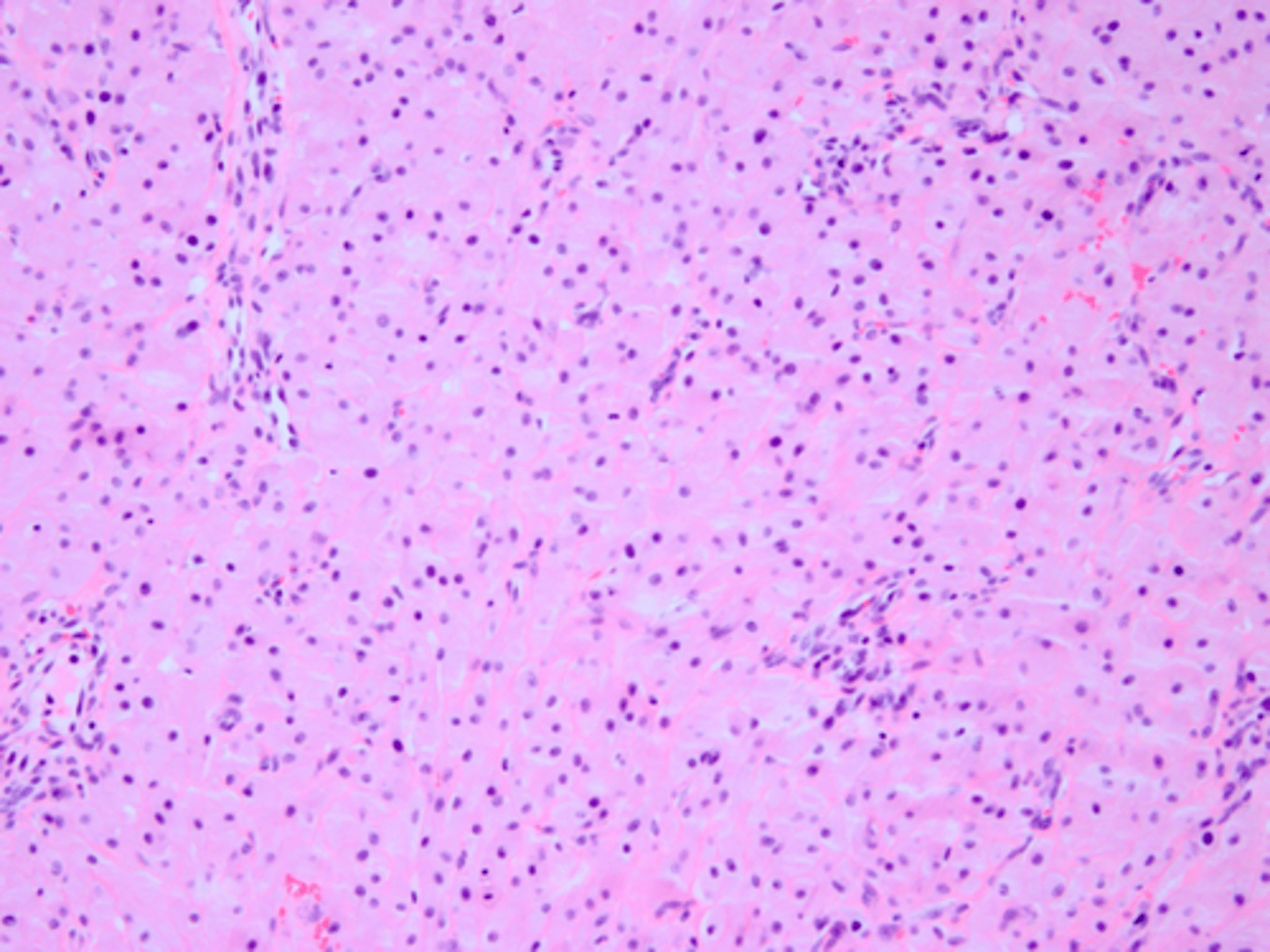<p>granular cytoplasm with NO pseudoepitheliomatous hyperplasia is associated with what pathology?</p>