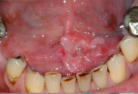 <p>what is the best management of this lesion </p>